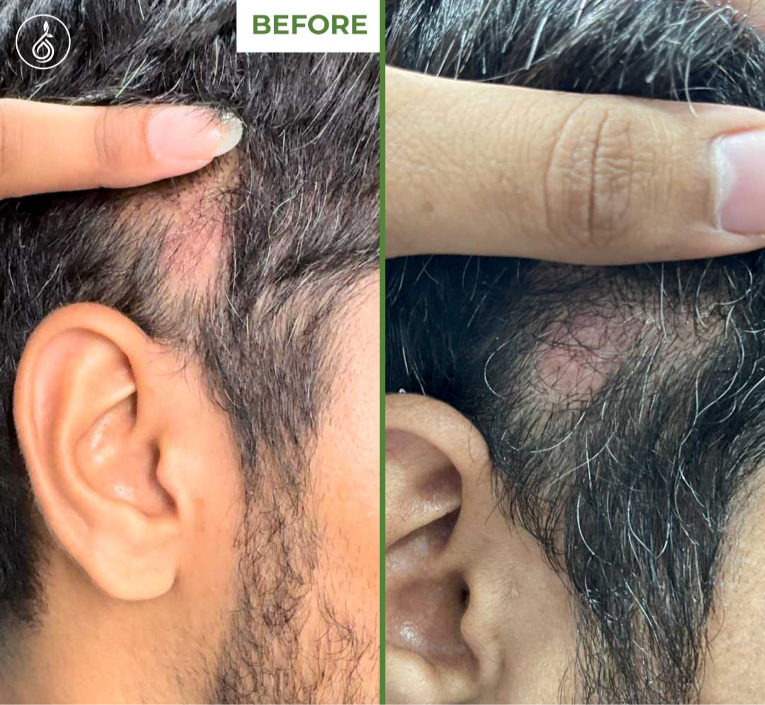 TDerma Roller For Hair Growth