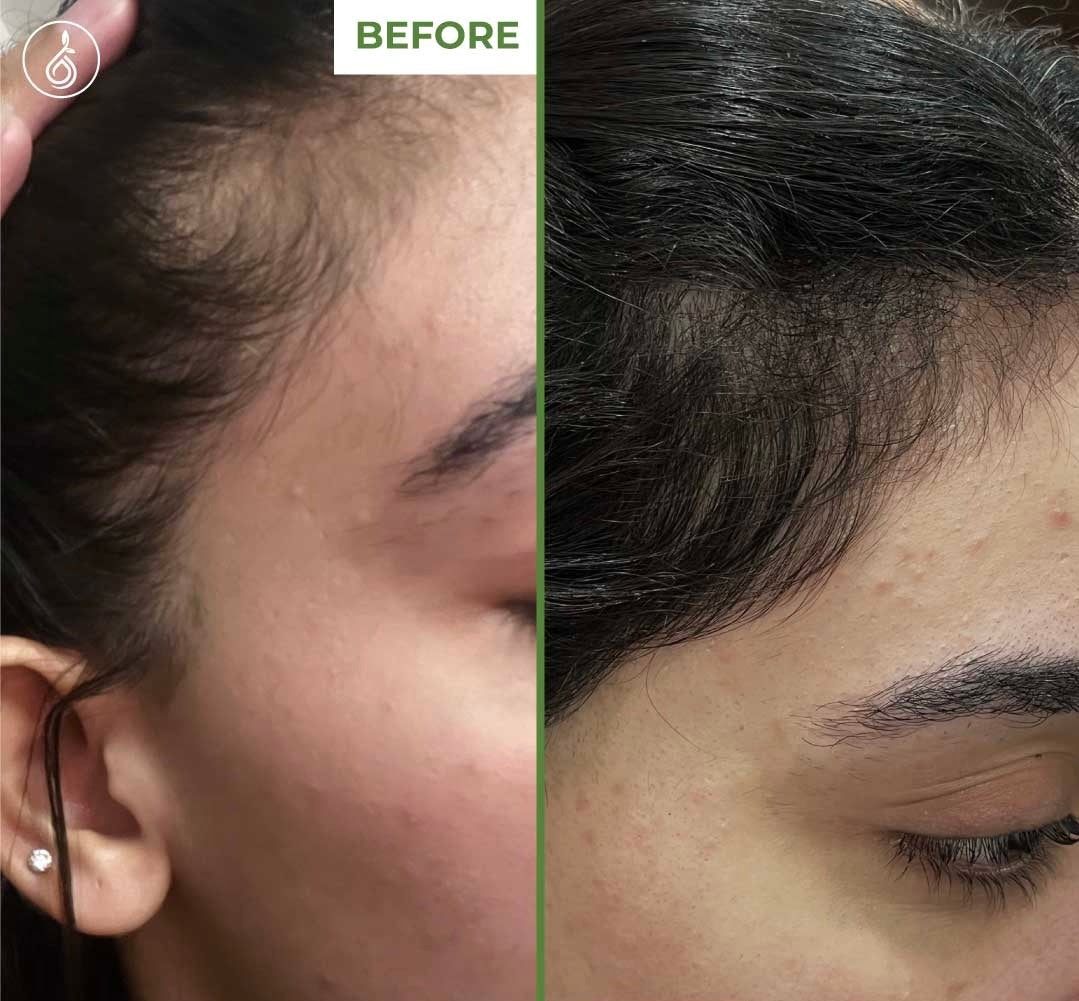 TDerma Roller For Hair Growth