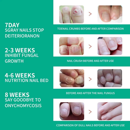 Nail Fungus Treatments Serum