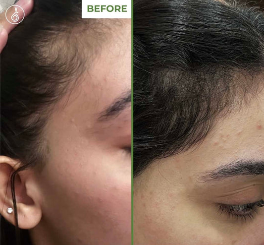 TDerma Roller For Hair Growth